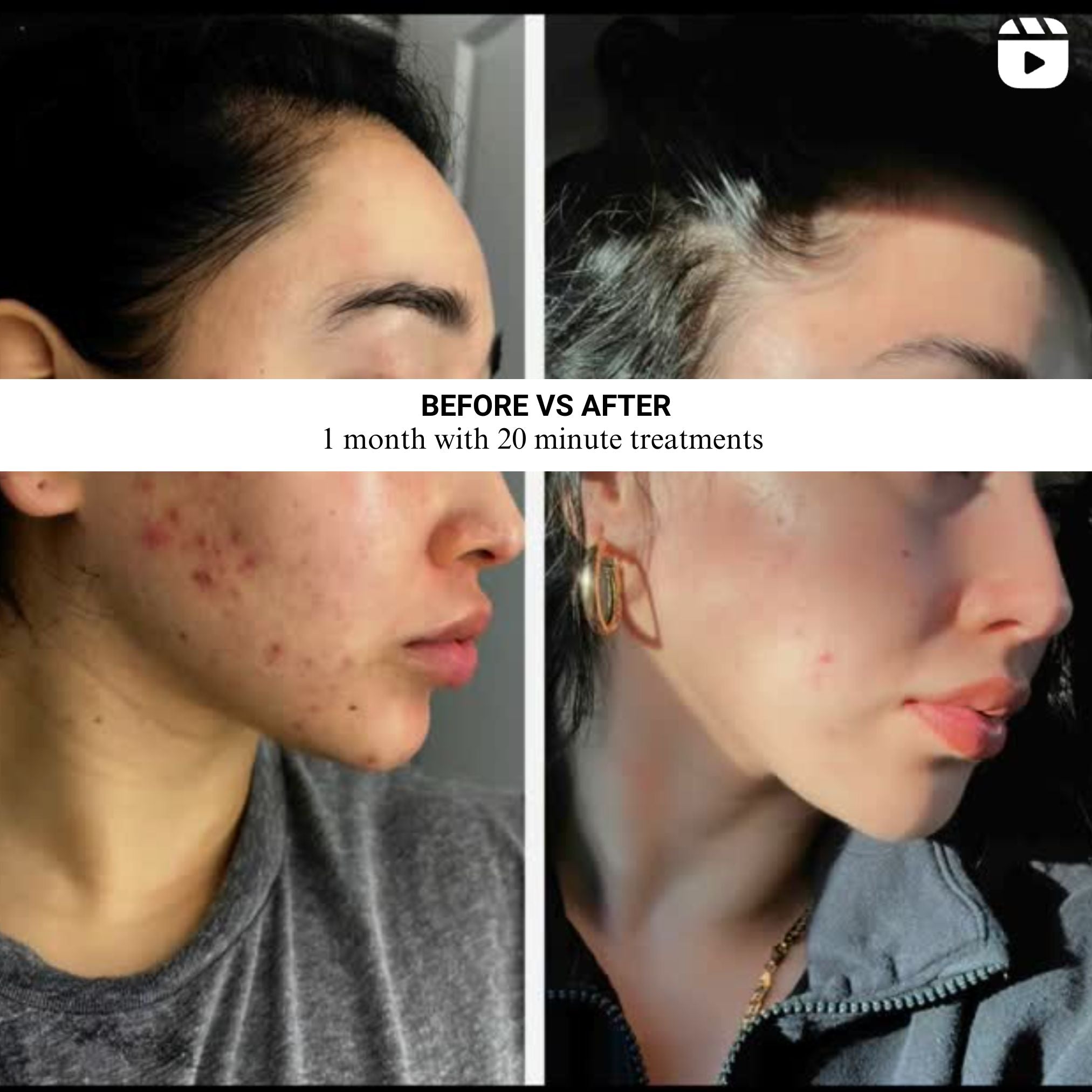 Before-and-after skin comparison photos showing results after one month