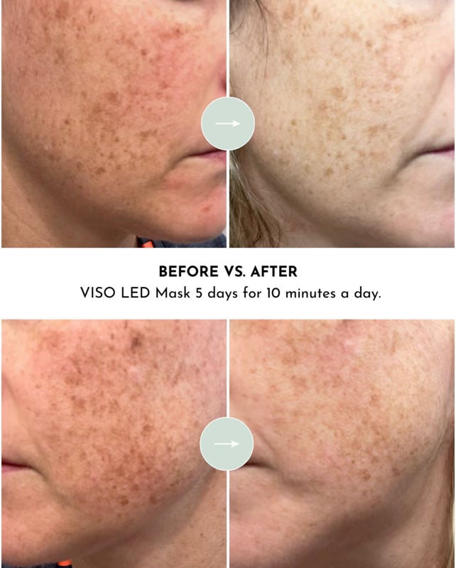 Before-and-after skin close-up showing results from using the Viso LED mask
